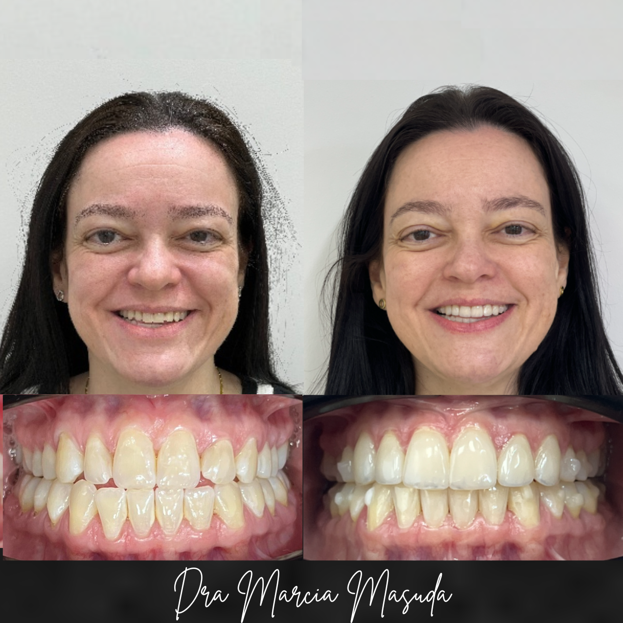 Antes e depois Invisalign – paciente 4
