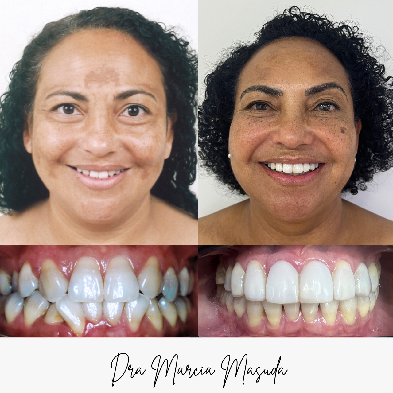 Antes e depois – caso Bianca Firmino