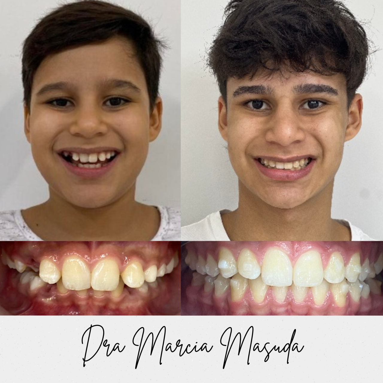 Antes e depois Invisalign – paciente 2