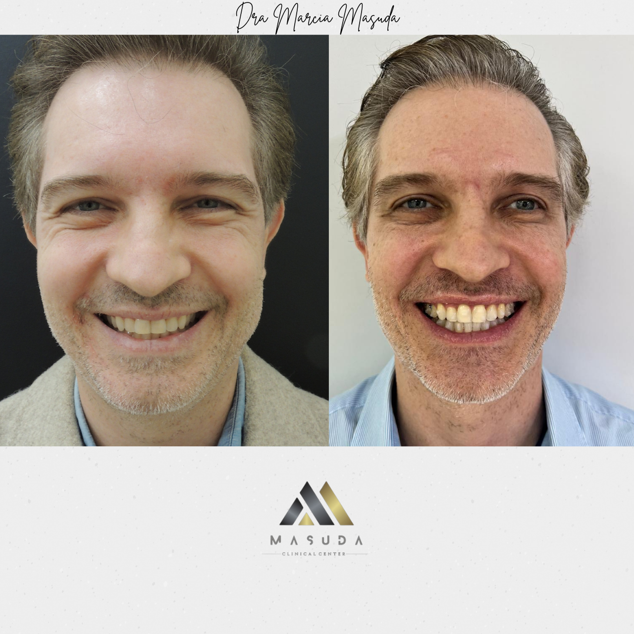 Antes e depois Invisalign – paciente 3