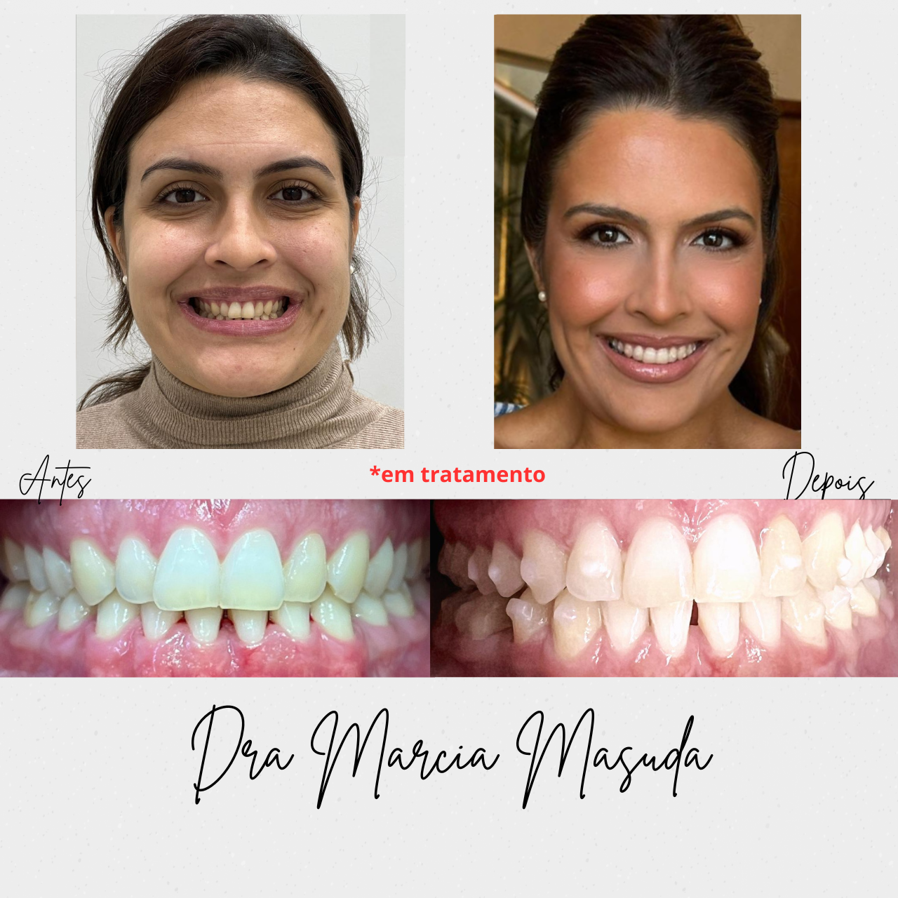 Antes e depois Invisalign – paciente 1