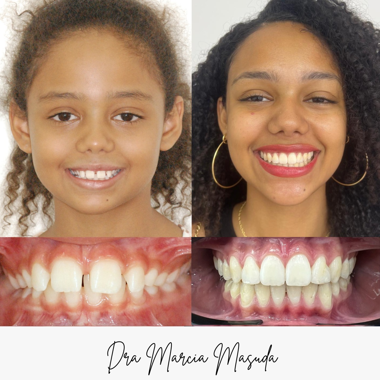 Antes e depois – caso Bianca Firmino